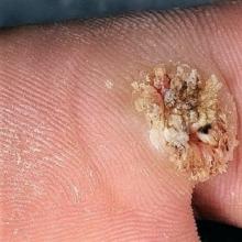 Treatment of warts on the foot in a child and adults